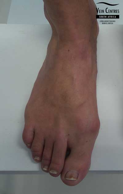 Treated varicose veins right foot