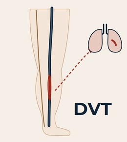 Diagram of a leg with a blood clot in a deep calf vein and part of the clot travelling to the lungs.