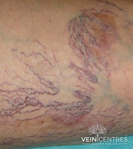 Photograph of extensive red and purple spider veins on the leg, with bluish feeder veins beneath them.